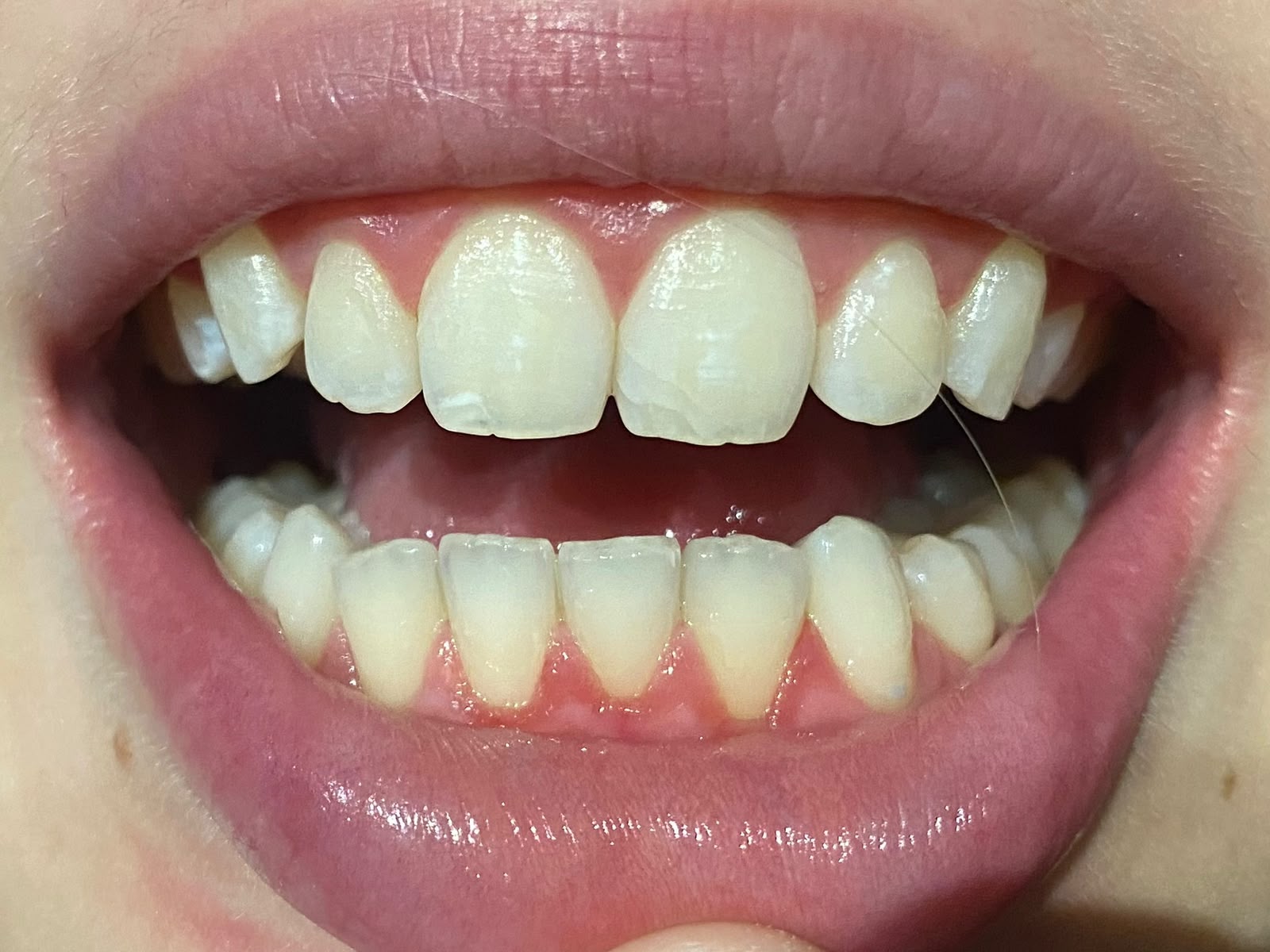 Depois do clareamento dental, paciente do Dr. Pedro Henrique Pinto